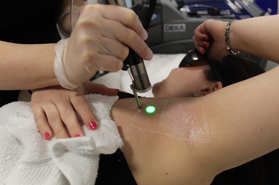 laser hair removal salon Birmingham, laser hair removal Birmingham 