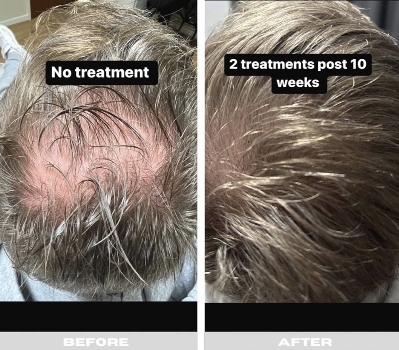 PRP Now Available at HUSH Salon Birmingham PRP Now Available at HUSH Salon Birmingham